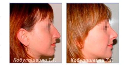 Ринопластика носа, особенности операции