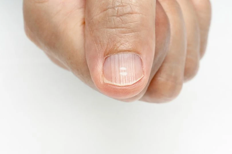 О каких проблемах со здоровьем расскажут ногти