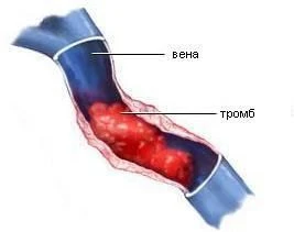 Причины образования тромбов