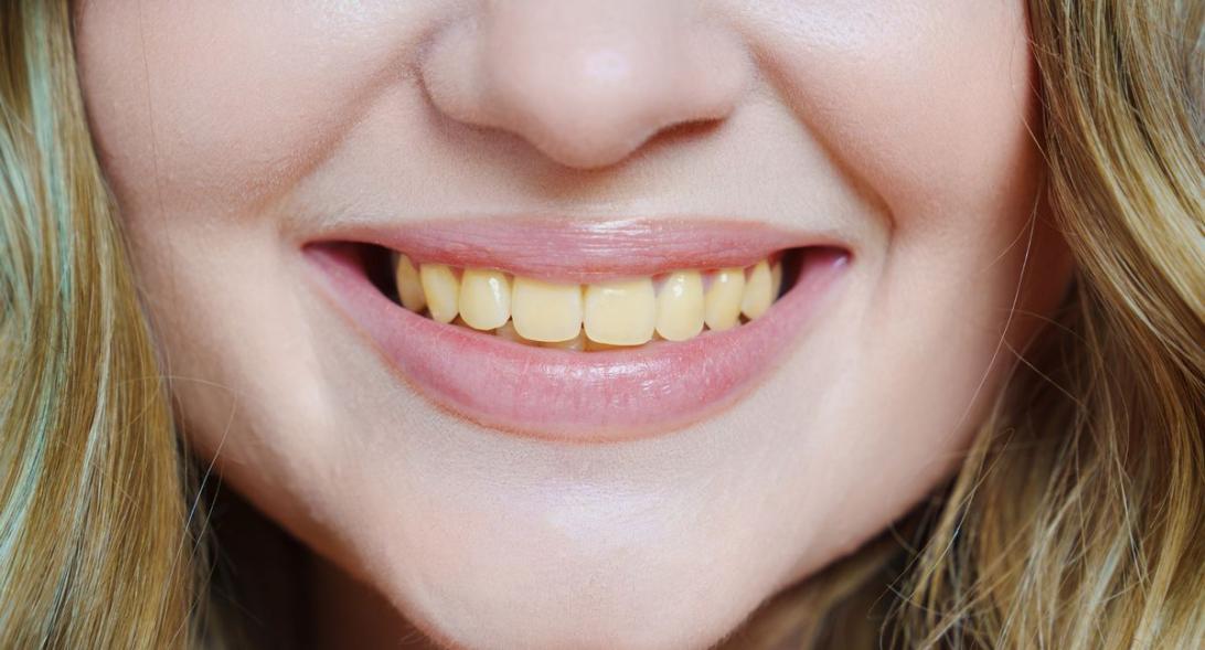 Крупный план улыбки женщины с желтыми зубами.
